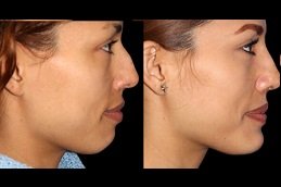 Best Chin Reduction cost in Riyadh