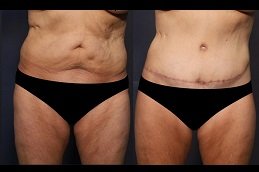 Best Fat Transfer Surgery cost in Riyadh