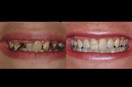 Best Hollywood Smile Design clinic in riyadh