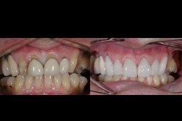 Best Hollywood Smile Design cost in Riyadh