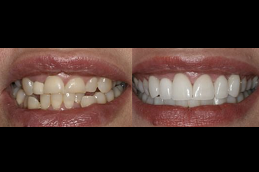 Best Hollywood Smile Design cost in Riyadh