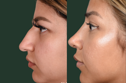 Best Silicone Nose Surgery Clinic in Riyadh