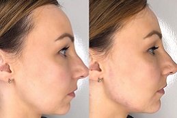 Best Silicone Nose Surgery in Riyadh