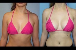 Breast Enlargement Injections cost in riyadh