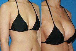 Breast Fillers Injections in Riyadh