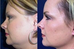 Chin Reduction in Riyadh