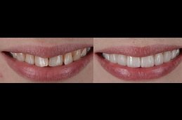 Hollywood Smile Design cost in riyadh