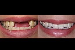 best Hollywood Smile Design in riyadh