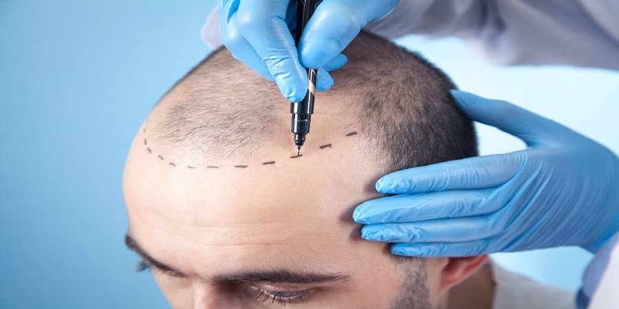 Best Hair Transplant method in Riyadh