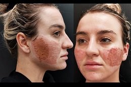 Best Acne Scar Treatment clinic in riyadh