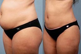 Best Bodytite Liposuction cost in Riyadh