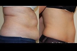 Best Bodytite Liposuction in riyadh