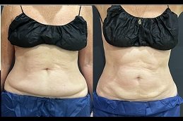 Best Bodytite Liposuction surgeons