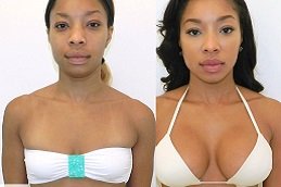 Best Breast Surgery surgeons