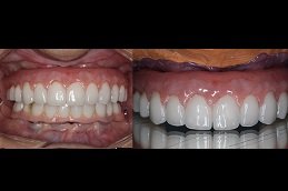 Best Dental Implants cost in Riyadh