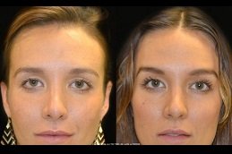 Best Forehead lift surgeons