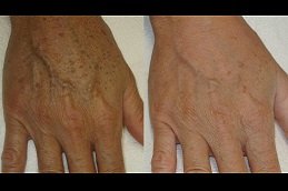 Best Hand Rejuvenation with Fat Transfer clinic in riyadh