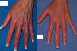 Best Hand Rejuvenation with Fat Transfer cost in Riyadh
