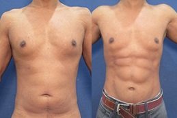 Best High Definition Liposculpture cost in Riyadh