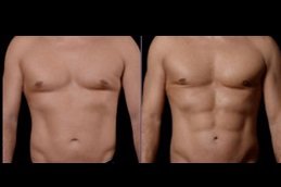 Best High Definition Liposculpture in riyadh