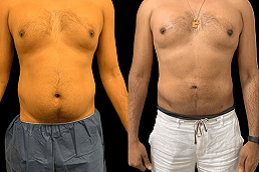 Best High Definition Liposculpture surgeons