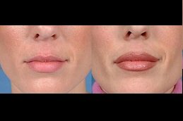 Best Lip Enlargement clinic in riyadh