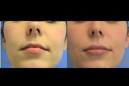 Best Lip Enlargement cost in Riyadh