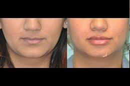 Best Lip Enlargement in riyadh