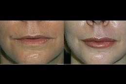 Best Lip Enlargement surgeons