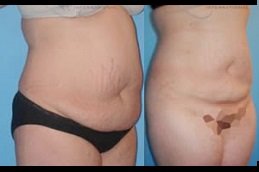 Best Vaser 4D Liposuction Clinic in Riyadh