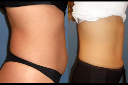 Bodytite Liposuction Clinic Riyadh