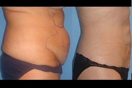 Bodytite Liposuction in riyadh