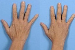Hand Rejuvenation with Fat Transfer in riyadh