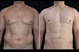 High Definition Liposculpture in riyadh