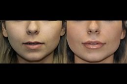 Lip Enlargement Clinic Riyadh