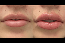 Lip Enlargement in riyadh