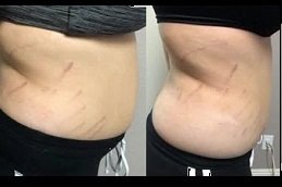 Best Body Contouring Treatment cost in Riyadh