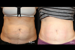 Best Body Contouring Treatment surgeons