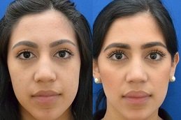 Best Buccal Fat Removal surgeons