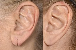 Best Ear Reshaping clinic in riyadh