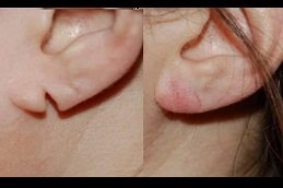 Best Ear Reshaping cost in Riyadh