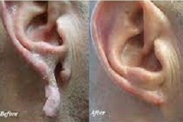 Best Ear Reshaping surgeons