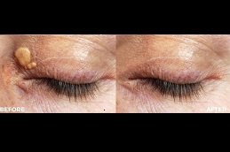 Best Eyelid Xanthelasma Removal in riyadh