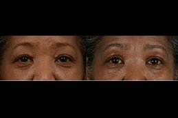 Best Eyelid Xanthelasma Removal surgeons