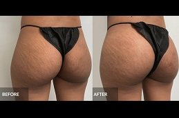 Best French Butt Reshaping in riyadh