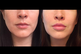 Best Lip Lift Surgery cost in Riyadh