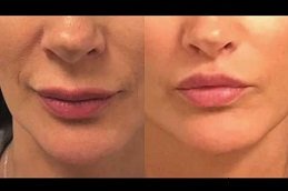 Best Lip Reduction Surgery clinic in riyadh