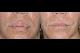 Best Lip Reduction Surgery cost in Riyadh