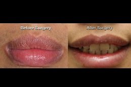 Best Lip Reduction Surgery in riyadh