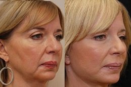 Best Make Over Cosmetic Surgery clinic in riyadh